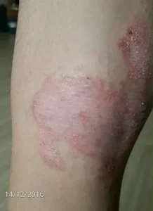 Trị Vẩy Nến Xe Ô Tô