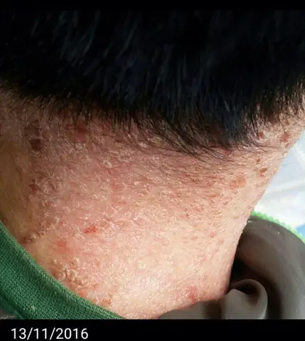 Trị Vẩy Nến Xe Ô Tô