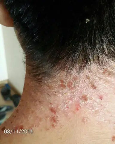 Xe Ô Tô Bị Vảy Nến Xe Ô Tô Bị Vảy Nến