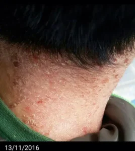 Xe Ô Tô Bị Vảy Nến